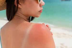 Sunburned,Skin,On,Shoulder,Of,A,Woman,Because,Of,Not