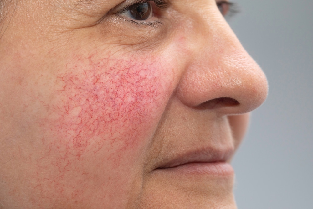 Rosacea Treatment Leon Valley TX