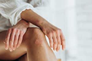 Close up of woman’s hands and knees experiencing a psoriasis flareup in the fall.