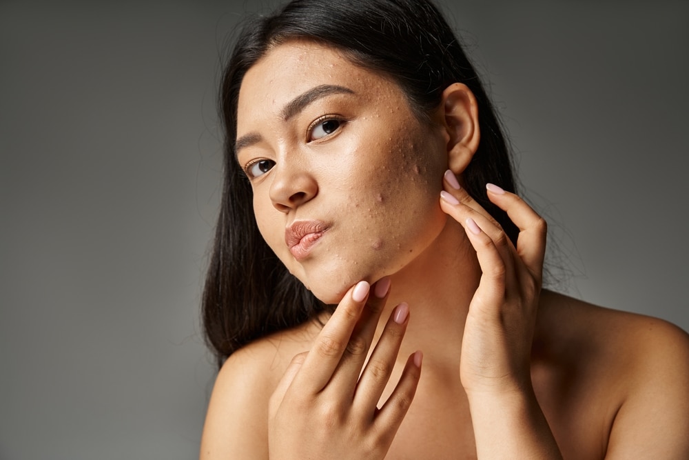 Woman showing the acne she has on her jaw and in need of acne treatment options.