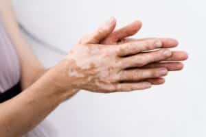 Vitiligo on a woman’s hands