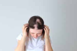 A woman with bald patches before PRP hair restoration in San Antonio