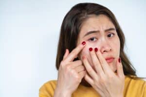 A woman looking at acne before starting Accutane®