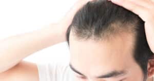A close-up shot of a man’s hair before PRP hair restoration in San Antonio