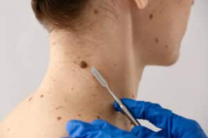 A dermatologist removing a mole with a lancet