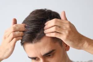 Man with psoriasis or dandruff scratching his scalp